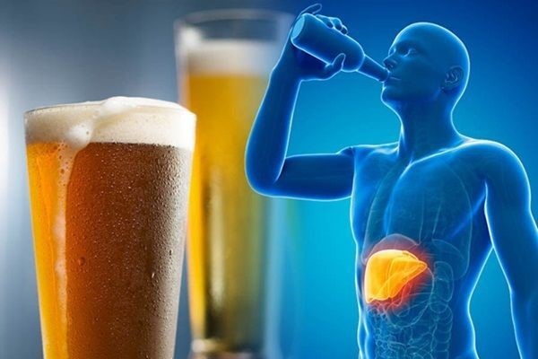 Uống bao nhiêu có thể dẫn đến viêm gan do rượu bia?